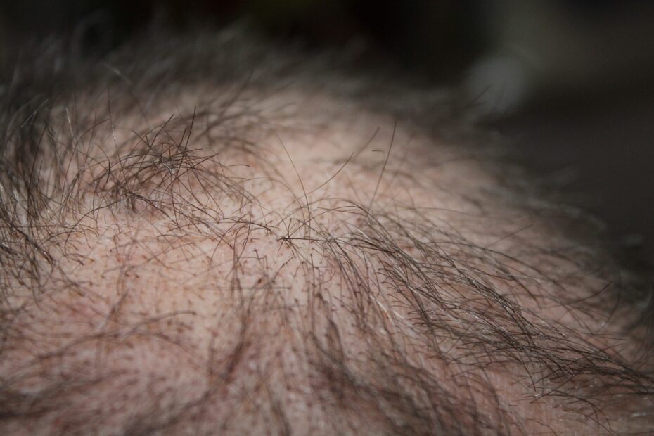 Hairloss after weight loss surgery